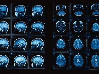 MRI techniques improve pulmonary embolism detection