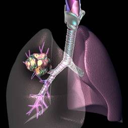 CT scans more effective than traditional lung cancer detection methods