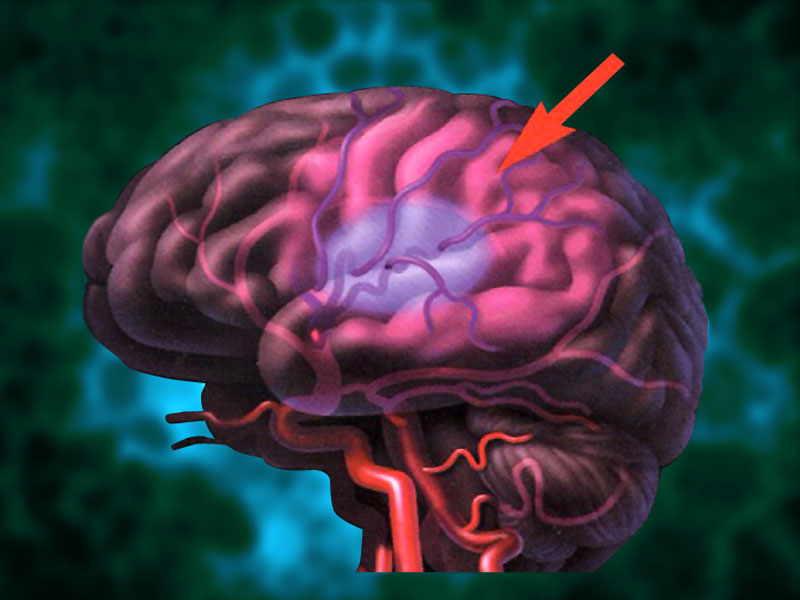 Brain Stroke Cases Register Alarming Rise Amongst Youth