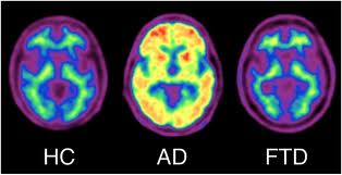 Piramal announces the acceptance for review of [18F] florbetaben by the FDA and EMA for the visual detection of Alzheimers