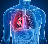 lung cancer treatment