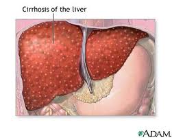 Novel Biomarker Could Potentially Lead to Early Detection of Liver Fibrosis