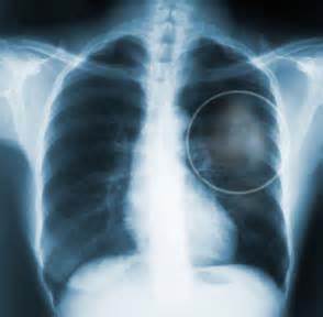 Collagen Clue Reveals New Drug Target for Lung Cancer