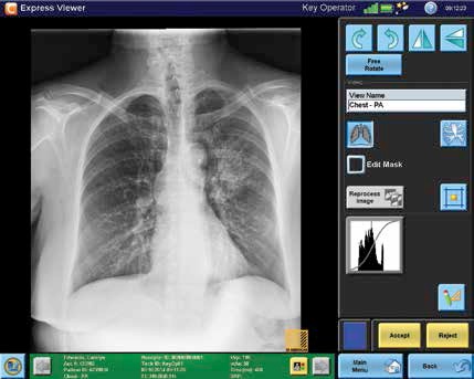 Carestreams New Bone Suppression Software Receives FDA Clearance, Now Available Worldwide