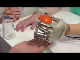 Bionic arm restores sense of feeling