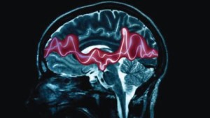 epilepsy-hyaluronan-genetics