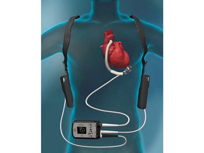 First successful transplant of HeartMate 3â„¢ conducted in India – LVADs soon to become popular among end-stage heart disease patients