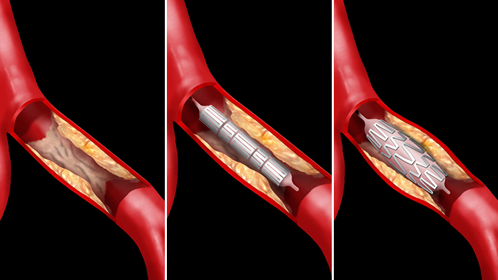 Govt warns firms creating artificial shortage of stents