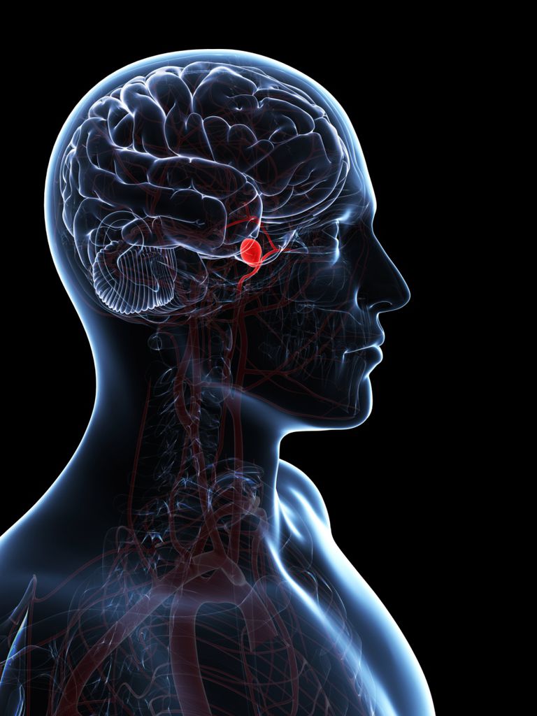 subarachnoid haemorrhage