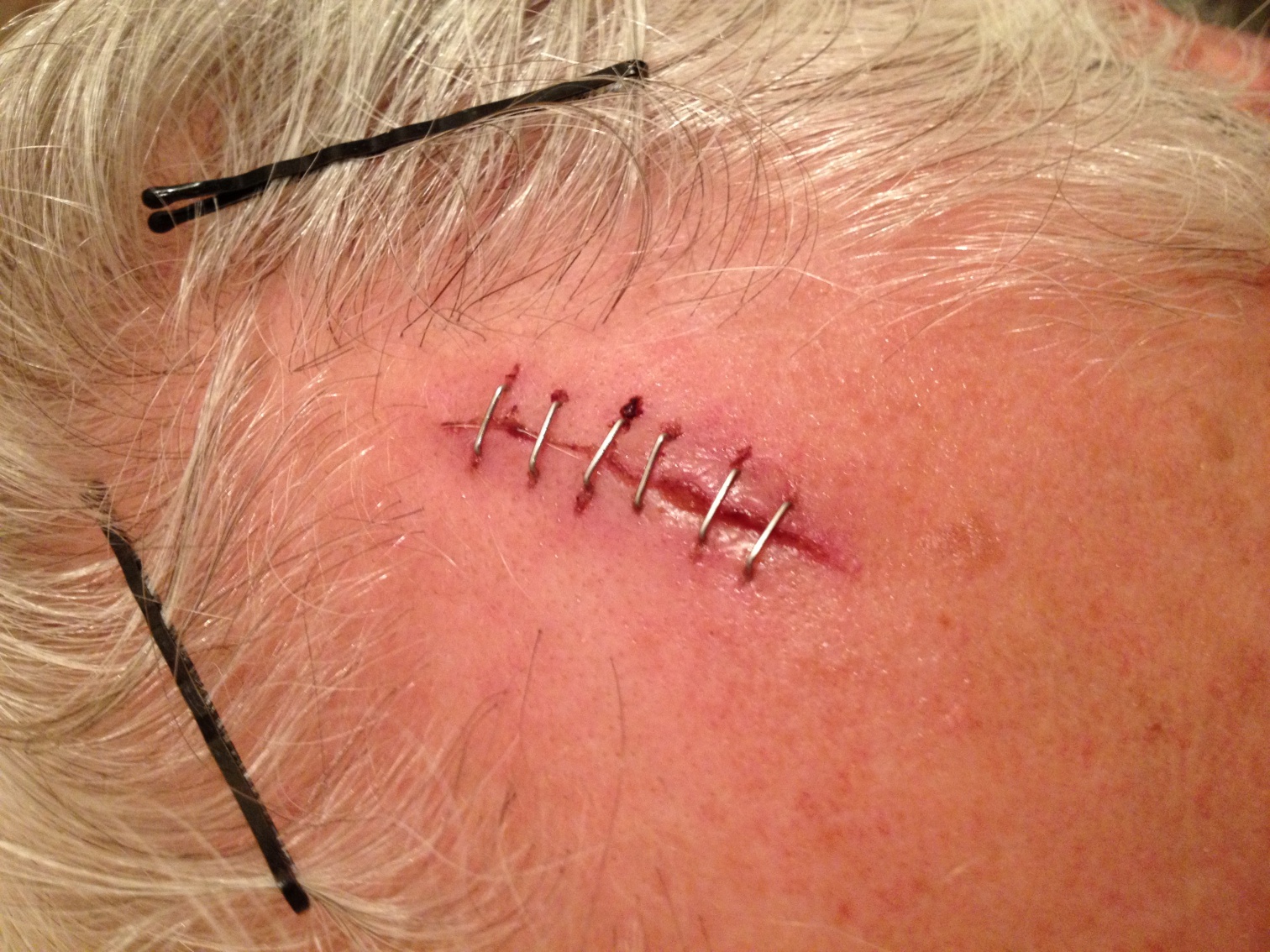 staples versus sutures