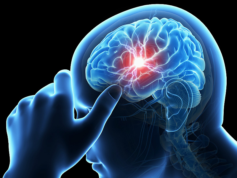 Connection between a stroke and sinusitis