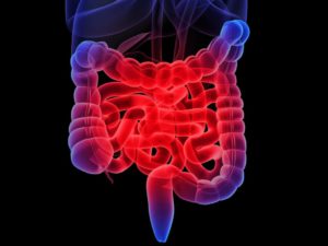 inflammatory bowel disease