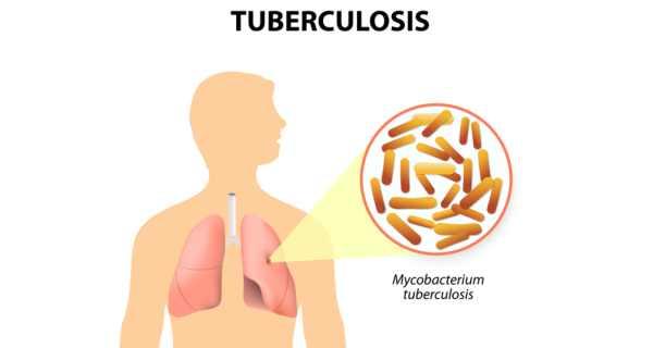 Non-antibiotic drug may help to treat tuberculosis