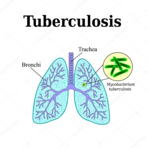 tuberculosis