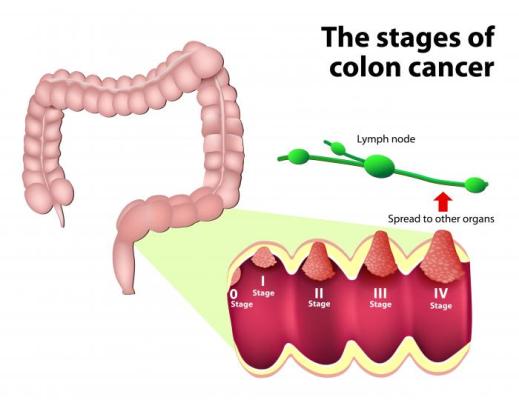 colorectal cancer