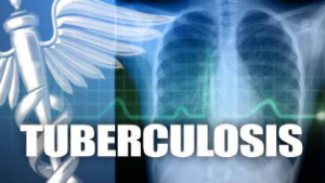 Tuberculosis