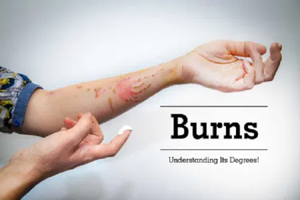 Tips on how to help a person with burns