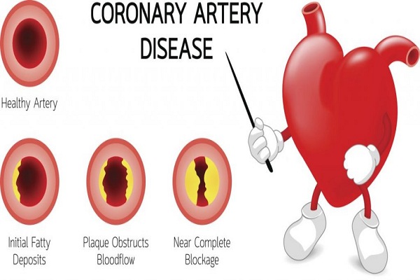 ‘Family history of heart disease a major risk factor in acquiring CAD’